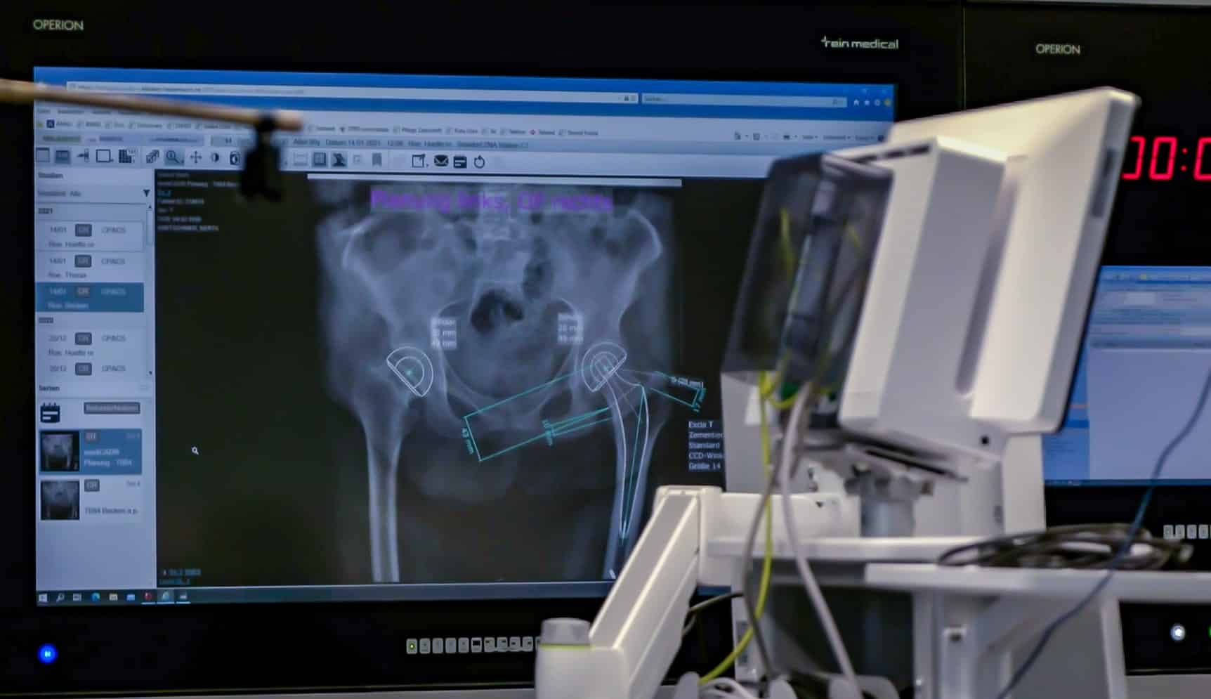 MInimalinvasive OP_03 Digitale OP-Planung auf Röntgenbild eines Beckens – medizinisches Bild auf Bildschirm mit Analyse-Software und chirurgischer Navigation.