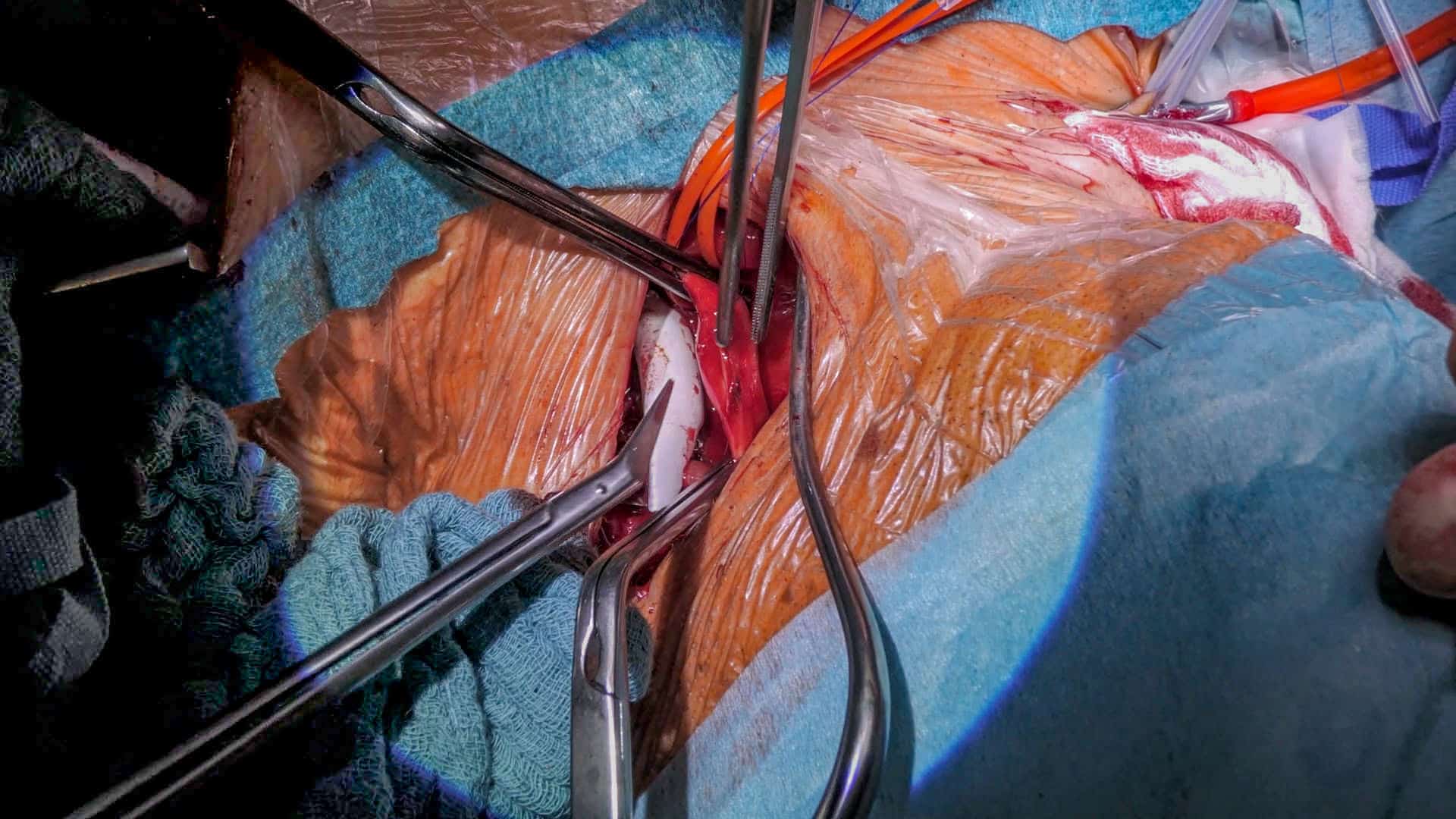 endovaskuläre_versorgung_stent_graft copy Nahaufnahme einer offenen chirurgischen Wunde während einer Operation. Mehrere chirurgische Instrumente halten das Gewebe offen, während ein weißer Stent-Graft in ein Blutgefäß eingeführt wird. Um die Wunde herum sind sterile Abdecktücher und blutige Verbände zu sehen.